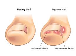Ingrown Toe Nail podiatrist