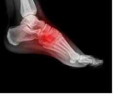 midfoot arthritis