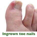 Best podiatrist for ingrown toe nails