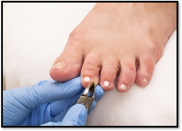 PDF] EVALUATING CLINICAL OUTCOMES OF NAIL SURGERY | Semantic Scholar